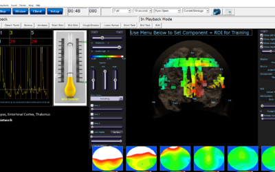 Neurofeedback Case Study: Brain Fog & Memory Loss